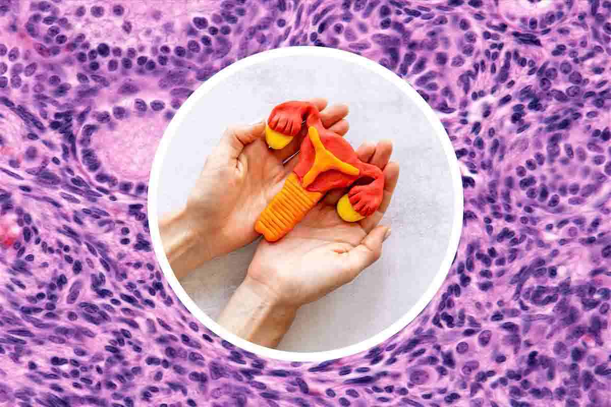 Cancro dell'ovaio: sintomi, diagnosi e fattori di rischio